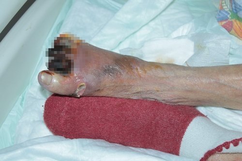 AYA?I KANGREN OLAN 90 YA?INDAK? KADININ HASTANEDEN GÖNDER?LD??? ?DD?ASI HASTANE ?DD?AYI YALANLADI