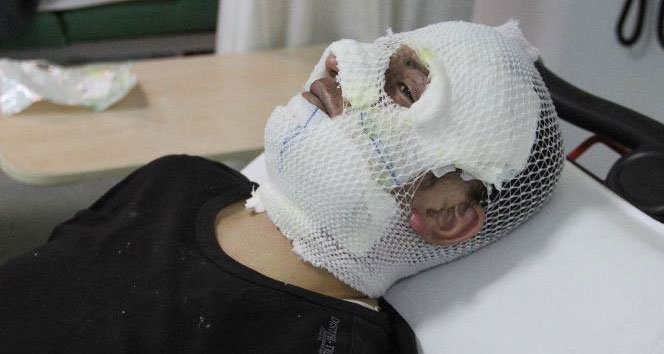 Yanan ateşe tiner dökünce hastanelik oldu