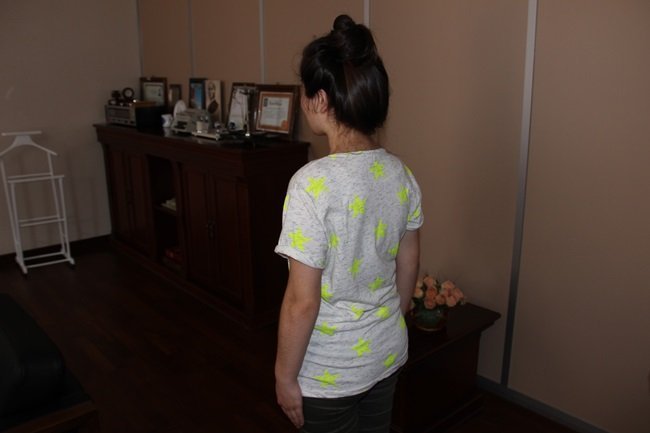 GAYE GÜNTAY OMURGASININ DÜZLEŞTİRİLMESİNİN ARDINDAN HEM VUCUDUNDAKİ EĞİRİLİĞİN HEMDE AĞRILARININ GİDERİLDİĞİNİ SÖYLEDİ. (VEDAT KILIÇ/ZONGULDAK-İHA)