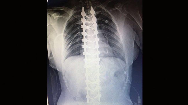 17 YAŞINDAKİ GAYE GÜNTAY'IN OMURGASI BAŞARILI BİR AMELİYAT İLE DÜZELEŞTİRİLDİ. (VEDAT KILIÇ/ZONGULDAK-İHA)