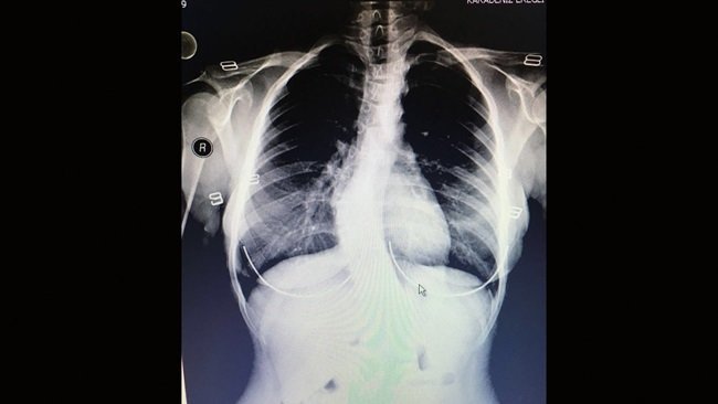 GAYE GÜNTAY'IN "S" ŞEKLİNDEKİ OMURGASI BEYİN CERRAHİ UZMANI OPR. DR. MUSTAFA KAYA TARAFINDAN YAPILAN AMELİYAT İLE DÜZLEŞTİRİLDİ. (VEDAT KILIÇ/ZONGULDAK-İHA)