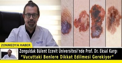 Zonguldak Bülent Ecevit Üniversitesi’nde  Prof.Dr. Eksal Kargı, ” Vucuttaki benlere dikkat edilmesi gerekiyor!