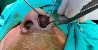 Zonguldak’ta 50 yıldır yüz kemiğinde kurşunla yaşayan hasta ameliyat edildi